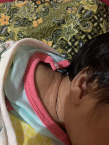 cemar peluh. macam mana korg buat baby naik biji2 merah kt leher dan lengan ?