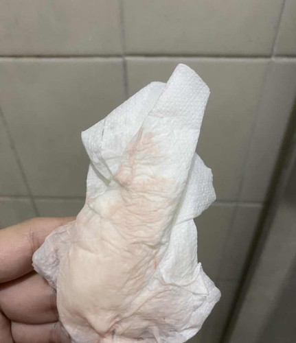 Discharge normal or hindi po?