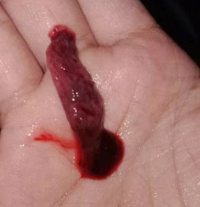 Miscarriage po ba ito?