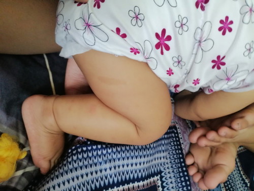 Best insect bite scar removal for baby