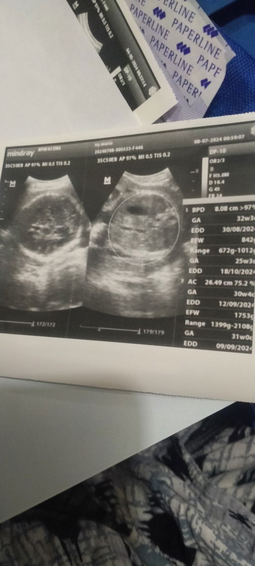 Berat badan bayi (usg)