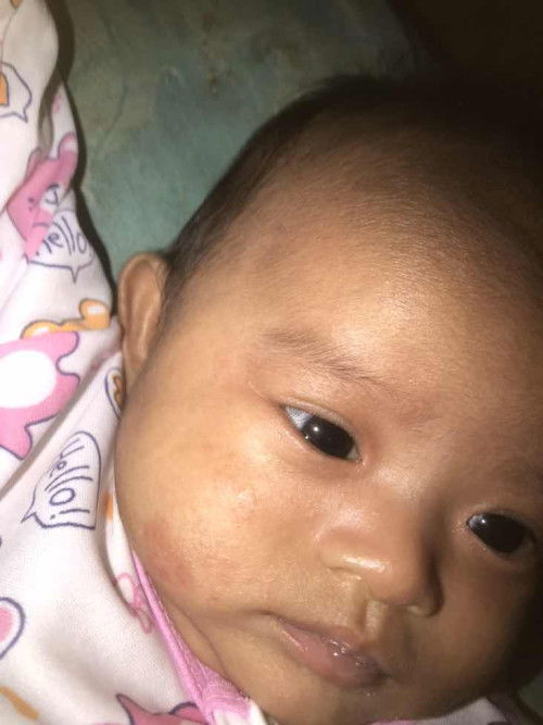 ลูกน้อยมีผดผื่นที่หน้าทายาอะไรได้บ้างค่ะ