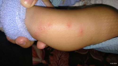 Ini gatal2 kenapa ya bund atau alergi susu kah ?