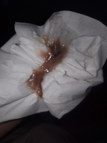 Apakah tanda bersalin keluar flek coklat Gini?  Solusinya gimna ya