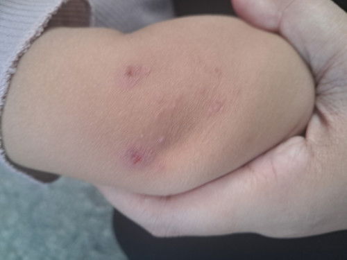 Bintik bintik lalu berdarah