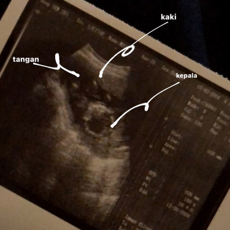 hasil USG 16 weeks