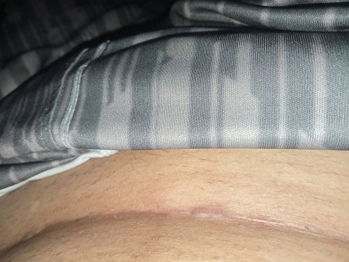 แผลผ่าคลอดได้1เดือน24วันแล้วแผลเป็นอย่างงี้ คือเป็นอะไรหรอคะ