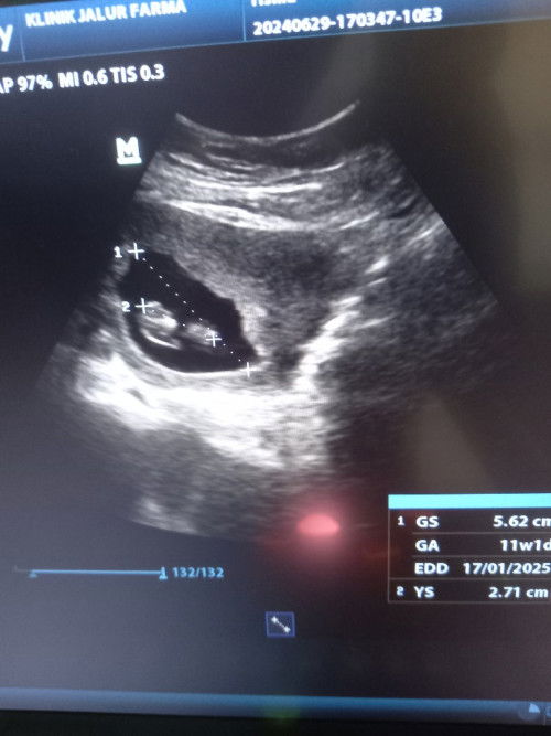 Ada yg sama ga bunda² dsni uk janin 11 minggu sperti yg d gambar
