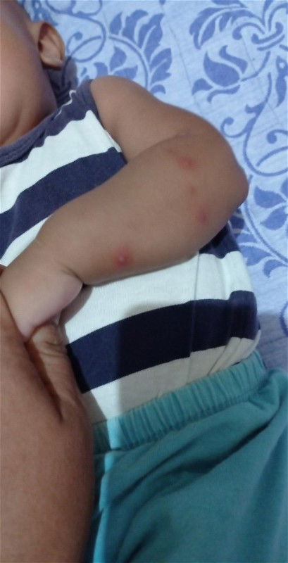 Allergy po ba eto kase pinaksin ko po siya ng itlog o ano po etong lumalabas na namumutla?