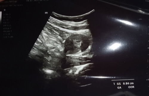 Artinya gimana ya Bun sama hasil usg itu ??