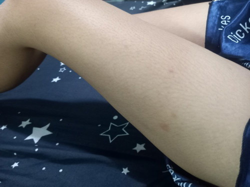 9w ผื่นขึ้นแบบนี้ปกติมั้ยคะแม่ๆ