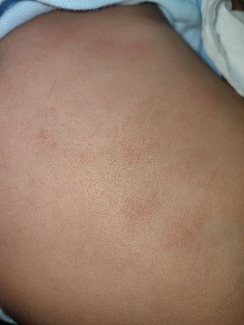 Merah kat badan baby 2bulan