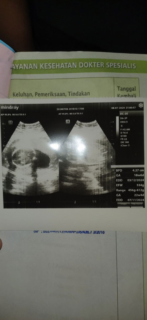 Hamil 18 w 6 d berat janin 500 gram lbh..terllu besar apa gmn ya mam..ada yang sama kah?