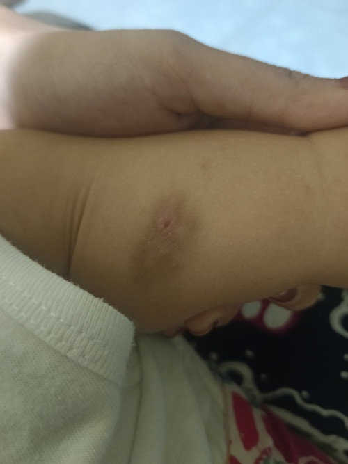 Bagaimana cara menghilangkan bekas gatal2 pada anak?