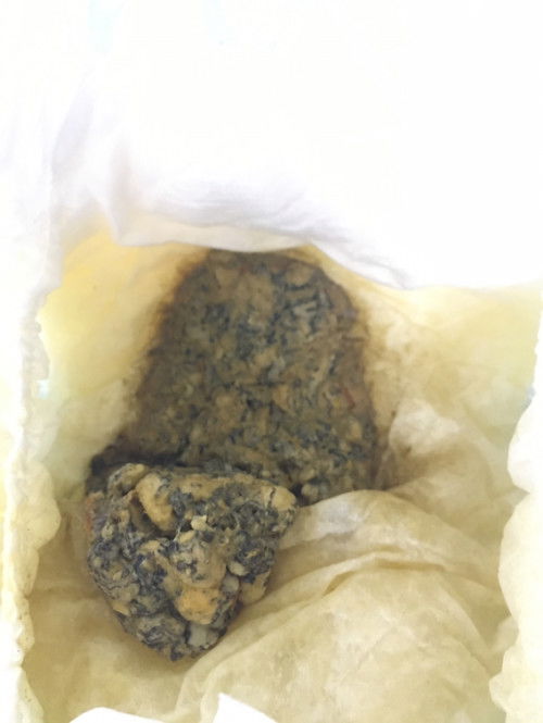 อึแบบนี้ ปกติไหมค่ะ