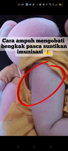 EDUKASI 01 - Cara mengobati bengkak bekas suntikan imunisasi