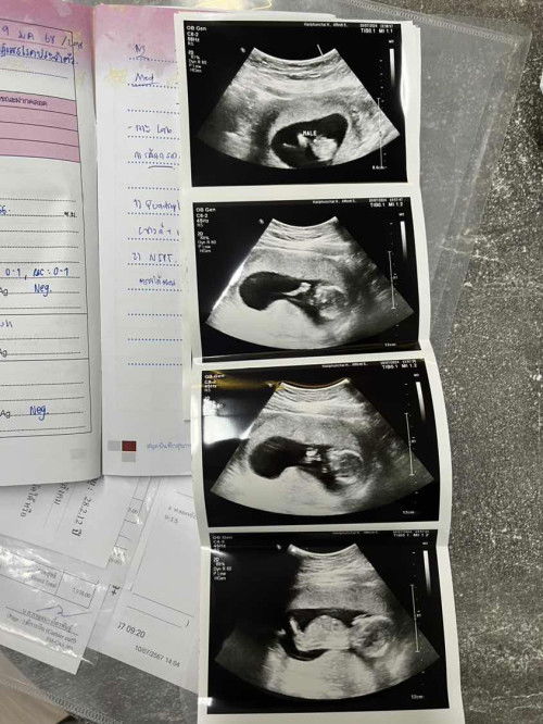 ผลตรวจ NIPT คลาดเคลื่อนได้ไหมคะ