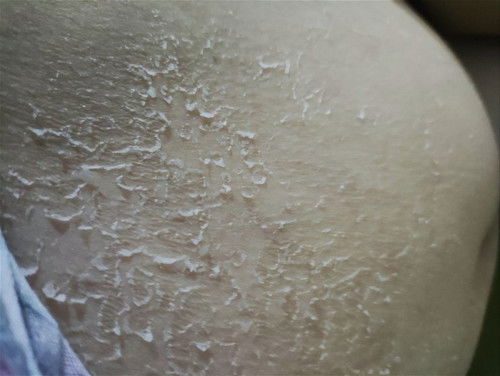 Kulit Perut mengelupas