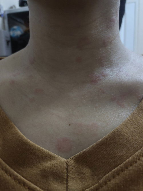 ผื่นคันขึ้นเต็มเลย