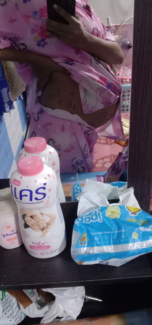 ครีมทารอยเเตก