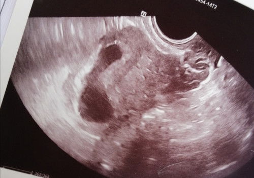 Kandungan tak menjadi, ada tak petua turun sendiri?