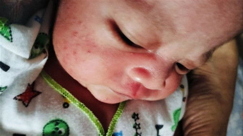 Ini anak saya mukanya kaya berutusan kenapa yah, ada yg perna mengalami. Kia kira obatnya apa