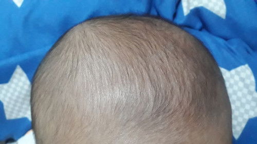 Kepala bayi 5 bulan ada kerak seperti ketombe