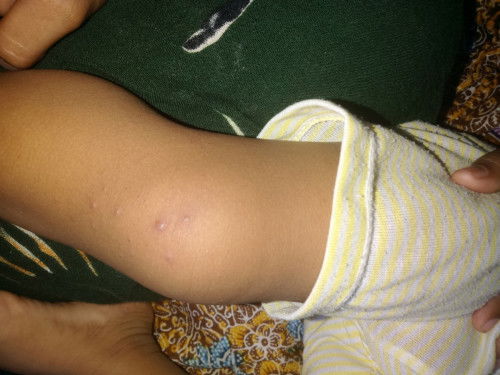 Bintik bintik pada lutut dan siku bayi