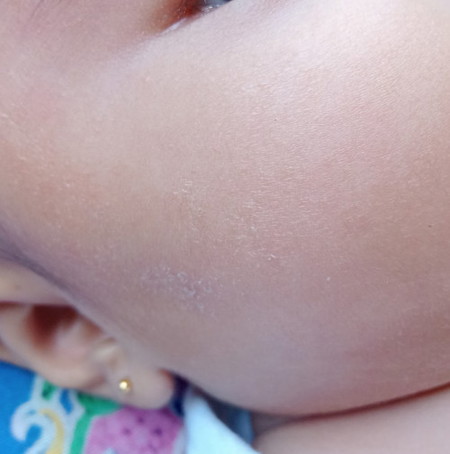 Kulit pipi bayi kering