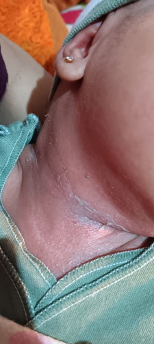 Lecet pada leher bayi