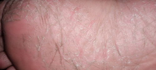 Telapak kaki kering pecah2