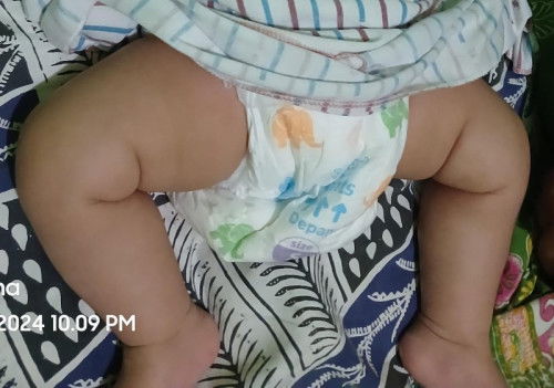 Bayi 3 bulan ukuran paha berbeda