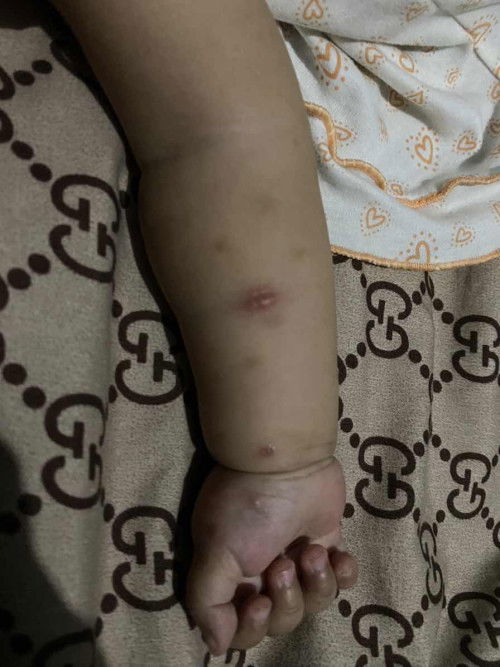 Bintik merah pada bayi