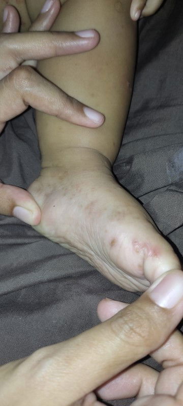 gatal gatal di kaki,paha dan merambat kemna²