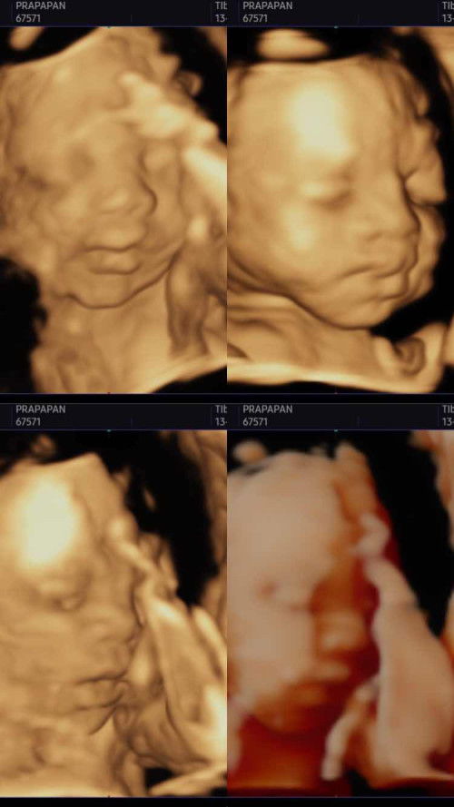 รู้ตัวช้าไม่ได้คัดกรองดาวน์ซินโดรมเป็นอะไรไหม