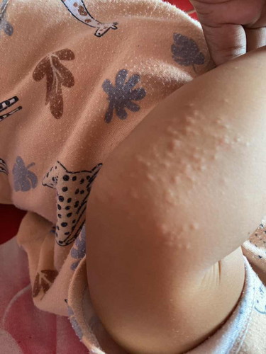 Bentol2 di siku dan kening