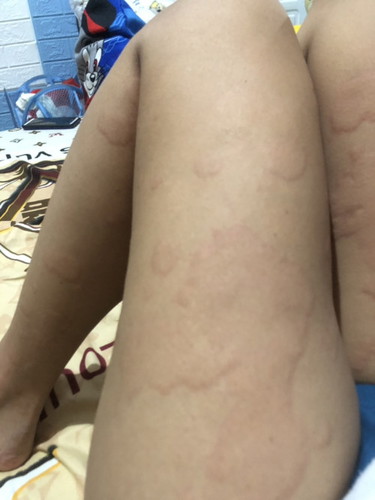 Pamamantal ng balat