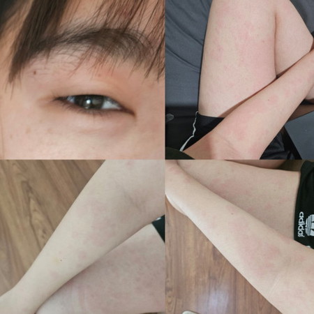 มีใครเคยเป็นลมพิษตอนตั้งครรภ์ไหมคะ