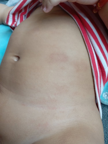 Baby Rashes