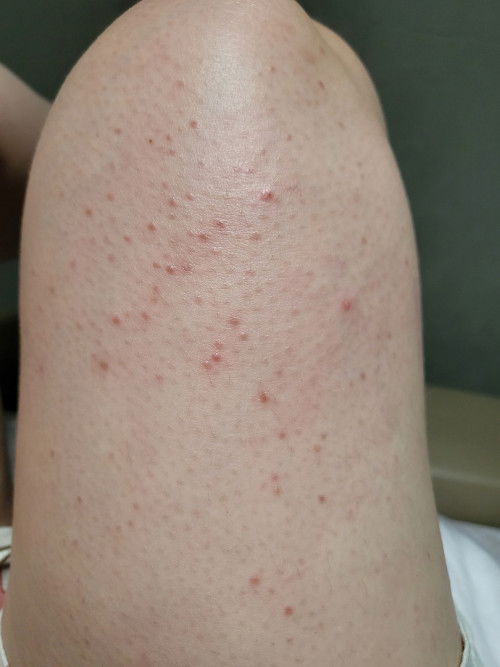 Red spots on thighs