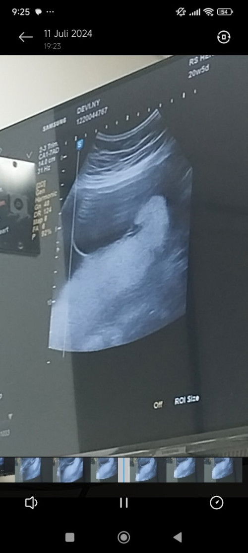 Di duga spina bifida bagi pengalaman nya bun 🥺 saya jadi ovt.