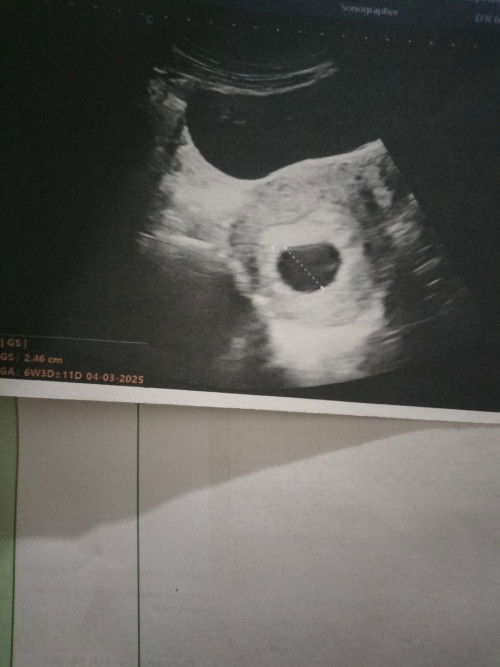 Hamil 6w5d USG abdomen/perut hanya terlihat kantung belum terlihat janin