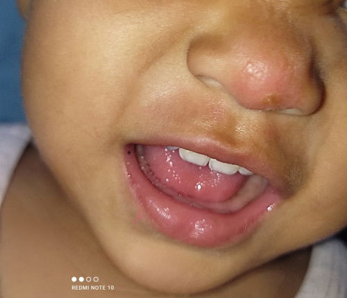 Hay bun ada yg bali tanya pernah ngalamin ruam d ujung hidung gini gak sih