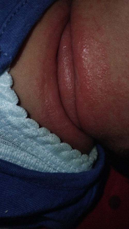 Ruam pada leher bayi