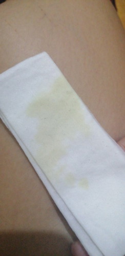 8weeks, normal po ba itong yellow green discharge?