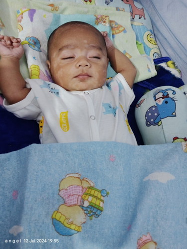 Bercak putih pada wajah bayi