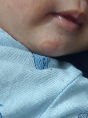 Bé nhà em bị cái mục dưới cằm 5 ngày rồi chưa thấy hết, xin các mom có kinh nghiệm