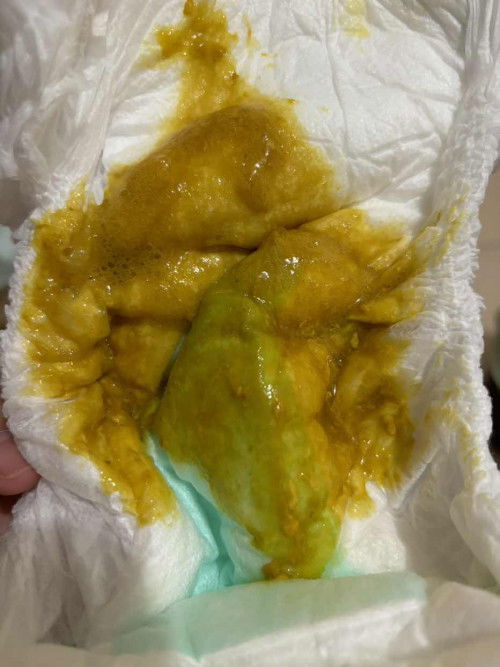 Najis baby ada lendir dan buih