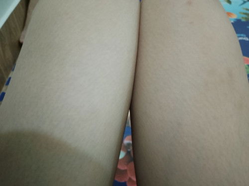 Các c oi cho em hỏi đây có phải rạn da không ạ 🥲