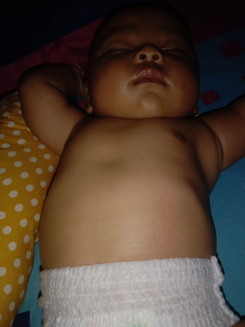 tulang rusuk menonjol